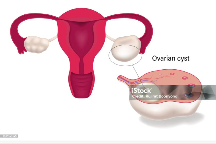 Polycystic Ovarian Disease (PCOD): Causes, Symptoms, and Natural Treatment Options in Ghana