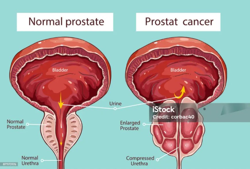 Natural Treatment for Prostate Enlargement (BPH) in Ghana